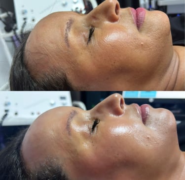 Comparaison avant et après en gros plan de la peau d’un client, montrant une amélioration visible de
