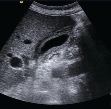 Ultrasound imge of the gallbladder showing thick walls.