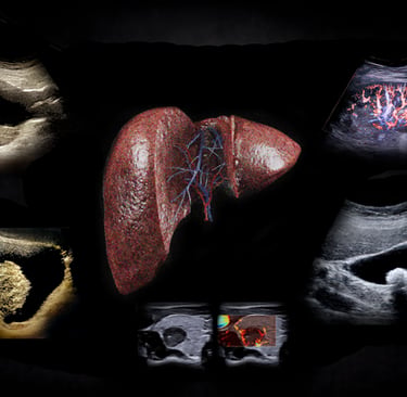 Image of the liver showing internal vessels with abdominal ultrasound images placed around it.