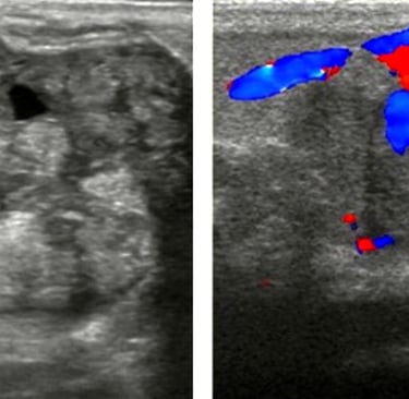 Ultrasound images of breast masses using color Doppler for hands-on training classes.