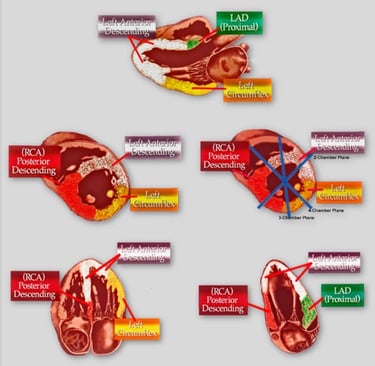 The heart-coronary artery distribution to regional walls.