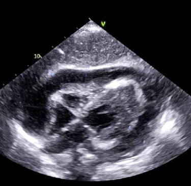 Ultrasound image showing tamponade in our hands-on POCUS training class.