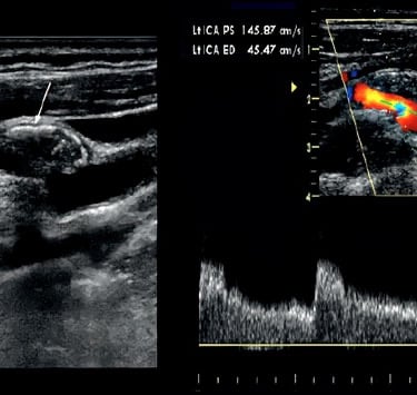 Duplex carotid ultrasound image showing vascular stenosis.
