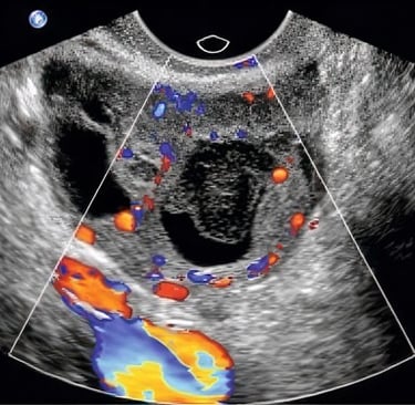 Ultrasound image of ovary with color Doppler in hands-on transvaginal training class.