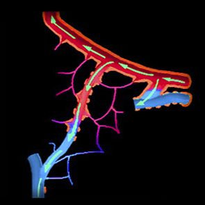 Medical illustration showing blood flow through an arteriovenous malformation AVM with green arrows.