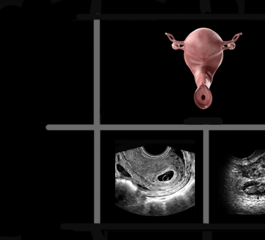 Panel of images showing transvaginal ultrasound findings.