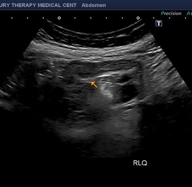 Ultrasonido de abdomen para diagnóstico de apendicitis en Hialeah realizado en Luxury Therapy Ultras