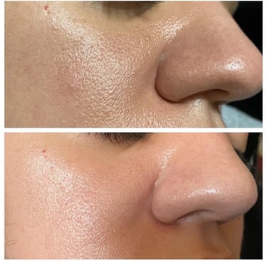 Microneedling treatment results in Coulsdon at SB Studio