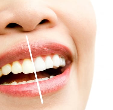 teeth whitening before and after