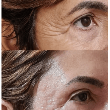 botox bh