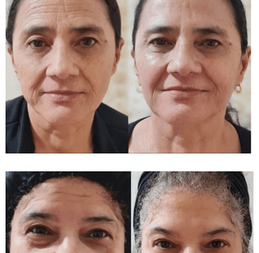 botox em bh