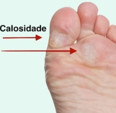 TRATAMENTO CALOS EM BH