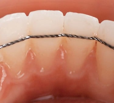  LA CONTENTION : L'ÉTAPE CLÉ POUR STABILISER VOTRE SOURIRE
