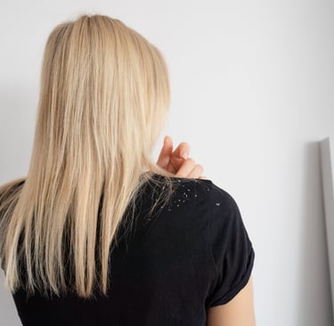 A woman with dandruff in her hair