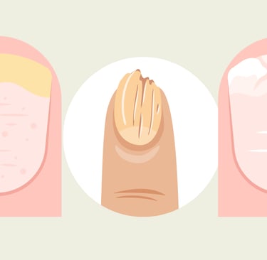 Broken and discolored fingernails