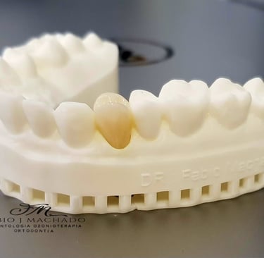 Molde Implante dentário com Dr Fabio Machado, Curitiba Batel