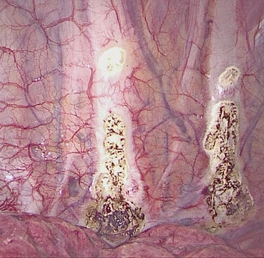 Hyperhydrosis treatment in Malta