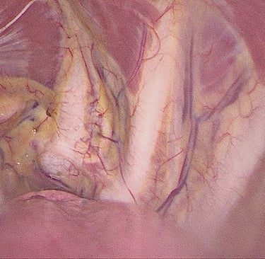 Hyperhydrosis surgery malta sweating