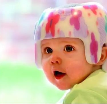 Plagiocefalia - Órtese Craniana