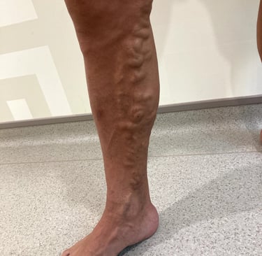 a man with a very large vein on his leg