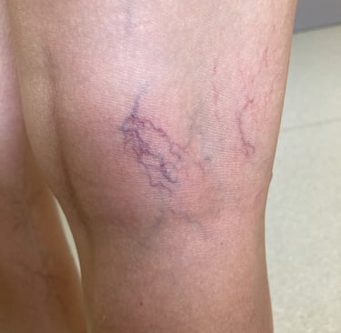 a woman with a vein on her leg