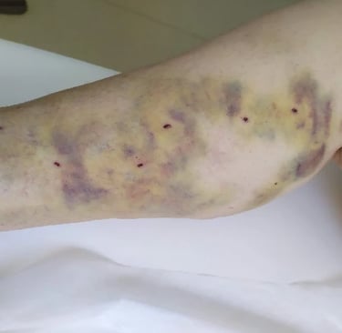 a person with a wound wound on their leg