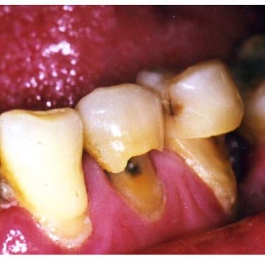 a image showing dental abrasion in teeth
