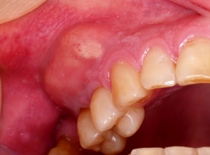 a image showing dental periodontal abscess