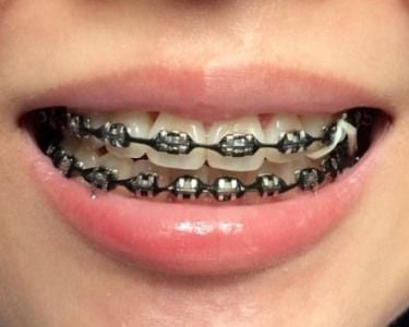 Close-up of a person smiling with black bands on braces, showing the popular braces color black opti
