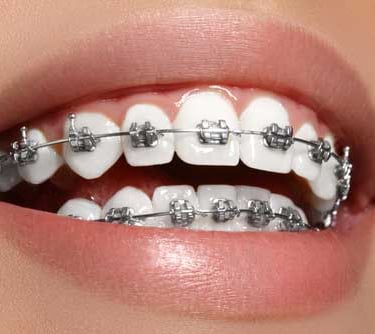 teeth with braces