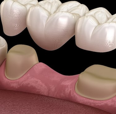 a dental bridge connecting premolar and molar teeth