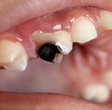 a image showing severly decayed tooth requiring root canal treatment
