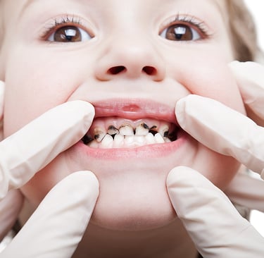 a image showing a girl's mouth with decayed tooth
