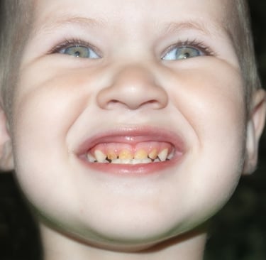 a smiling child anterior teeth affected by caries 