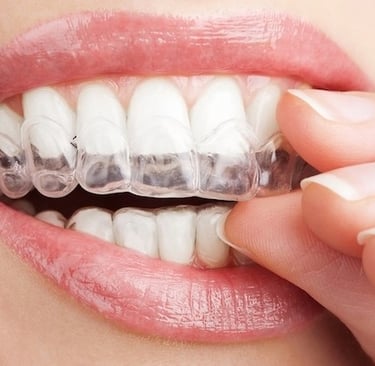 a person wearing clear aligners 