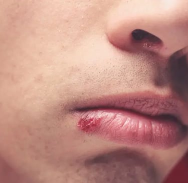a person mouth having cold sore on lips