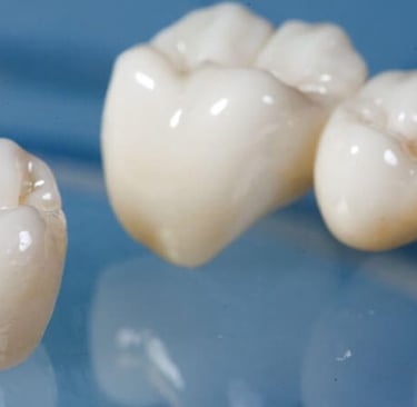 an imge showing dental bridge 