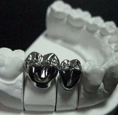 A Mettalic dental crown is placed on teeth