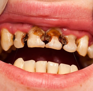 mouth showing caries or cavities in teeth