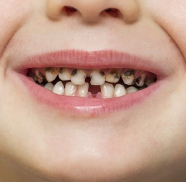 a image showing caries in all anterior teeth in kids mouth
