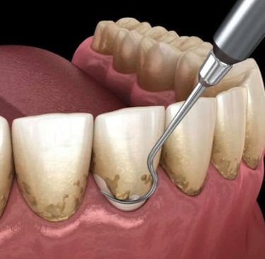 a image showing scaler used to scaling in anterior 