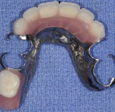 a image showing partial denture