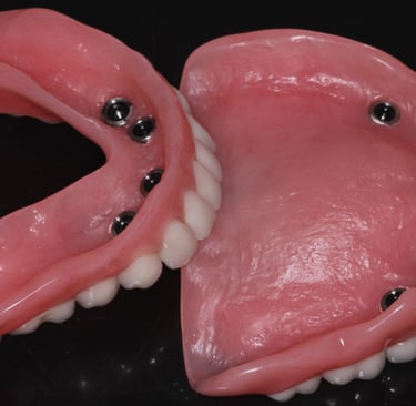 a image showing implant dentures