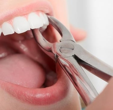 a tooth is being removed with forceps