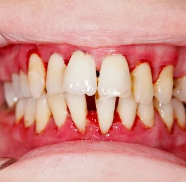 an image showing swollen gums 