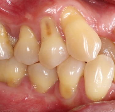 a image showing receding gums