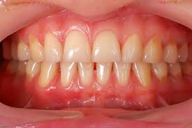 a image showing healthy gums 