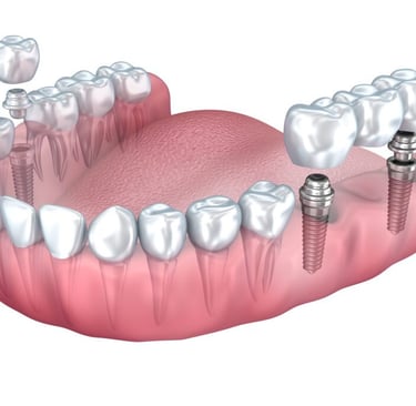 a image showing dental implants with crown being placed