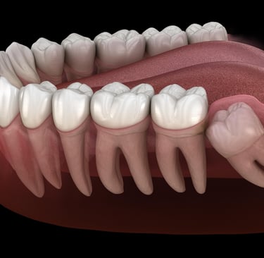 a image showing impacted wisdom teeth in the dental arch