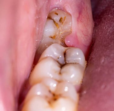 a image showing impacted wisdom third molar
